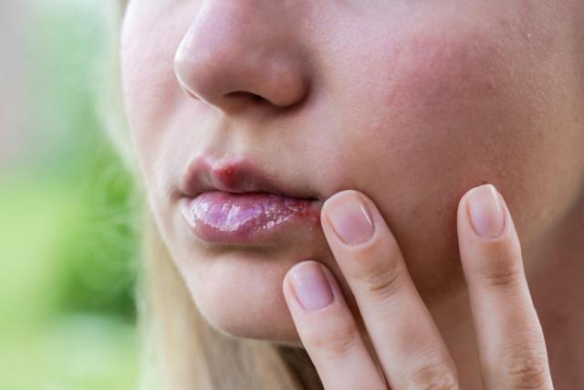Opryszczka (zimno) na ustach – przyczyny, objawy, leczenie